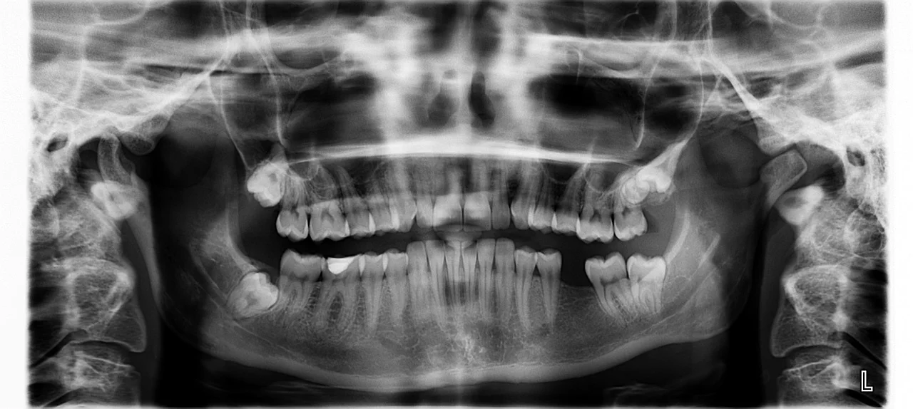 Radiografía Periapical